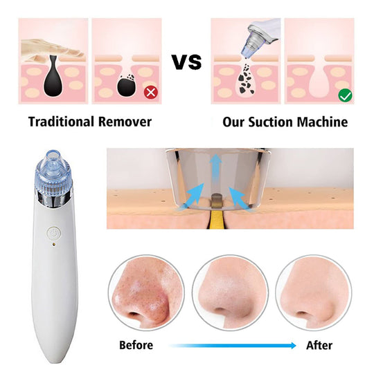 Rechargeable 4 in 1 Blackheads Removal Machine